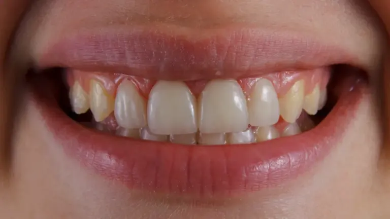 Dreams About Teeth Falling Out: Folklore and Reflection